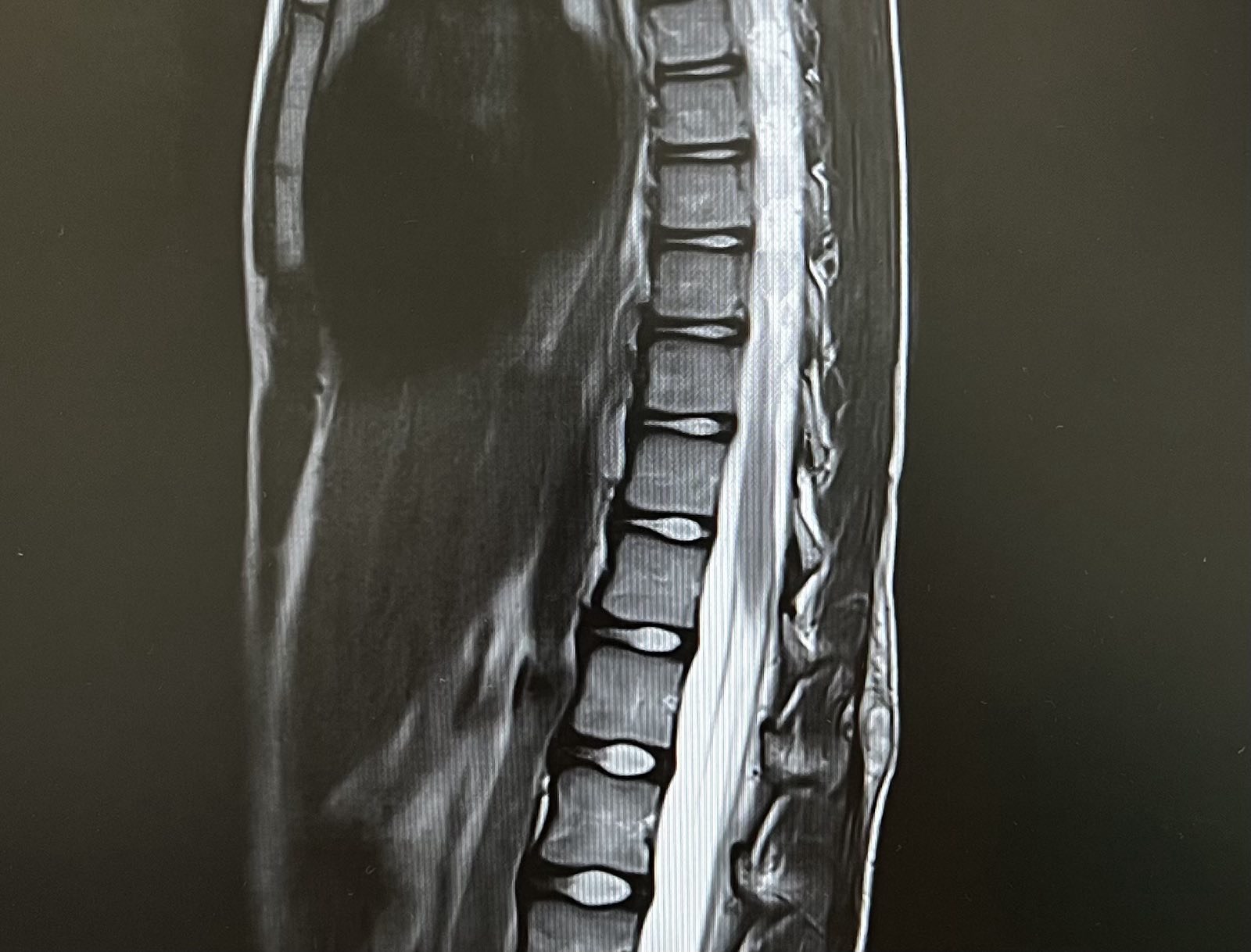 Οβελιαία τομή MRI της θωρακοοσφυϊκής μοίρας της σπονδυλικής στήλης